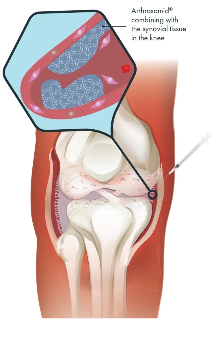 Arthrosamid® – Abbildung 2